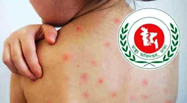 হামের উপসর্গ নিয়ে আরও ৫ শিশুর মৃত্যু