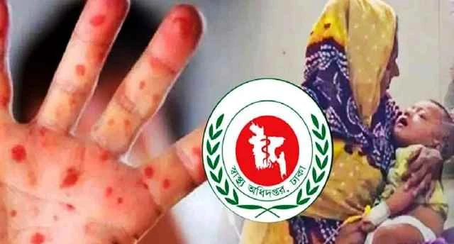 হাম ও হামের উপসর্গ নিয়ে আরও ৭ শিশুর মৃত্যু